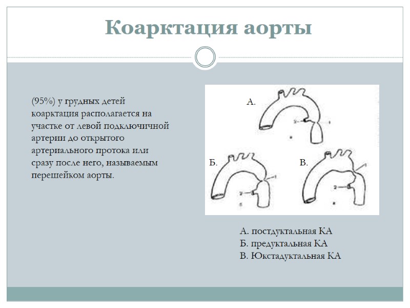 Коарктация аорты  (95%) у грудных детей коарктация располагается на участке от левой подключичной